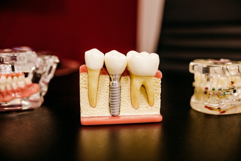 The Evolution of Dental Implants: Past, Present, and Future.