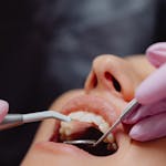 Close-up of a patient’s mouth during a dental exam with a mirror, dental tool, and gloved hands.