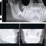 Panoramic dental X-ray on a screen showing teeth and jaw structure.