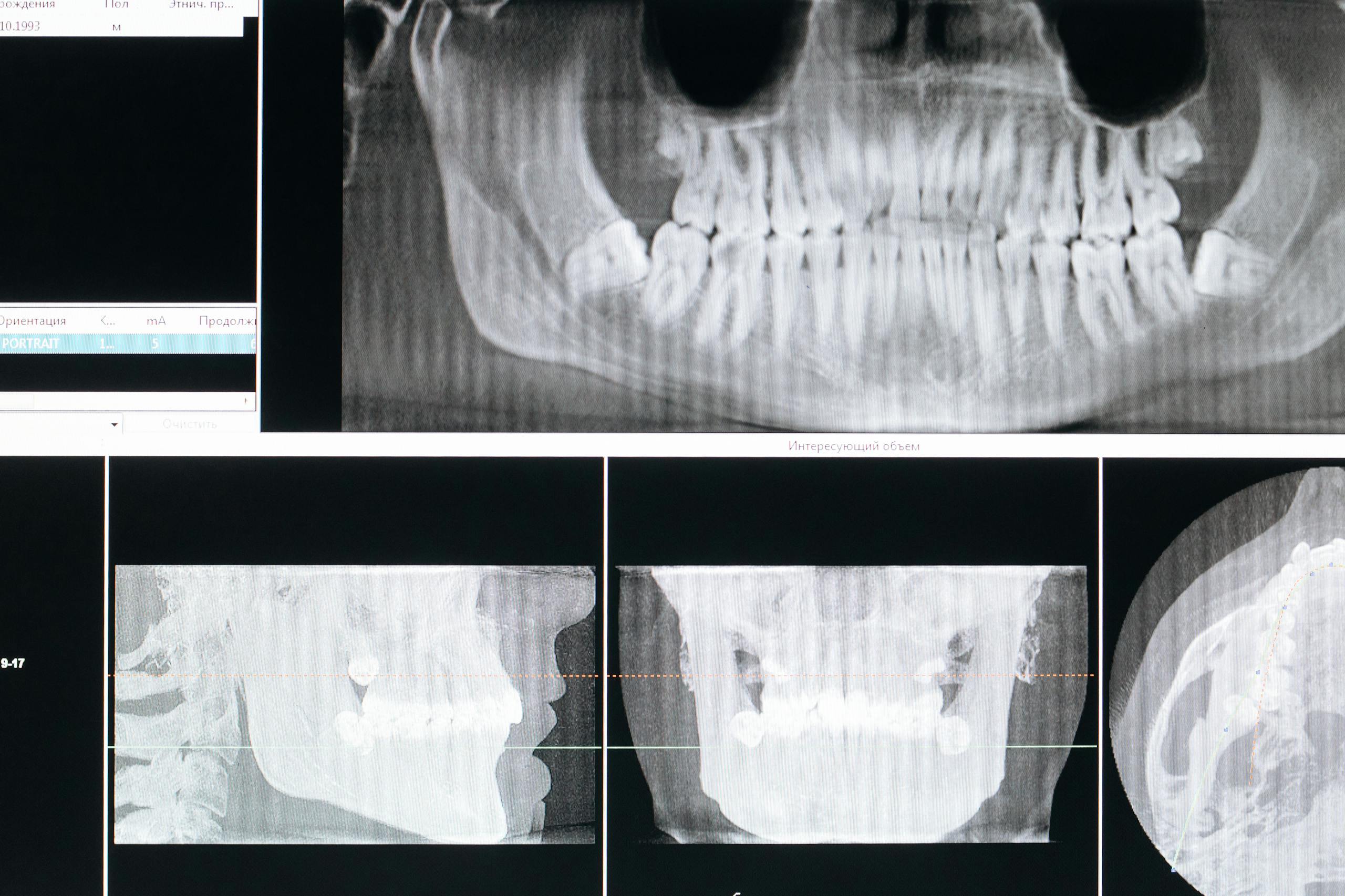 Panoramic dental X-ray on a screen showing teeth and jaw structure.