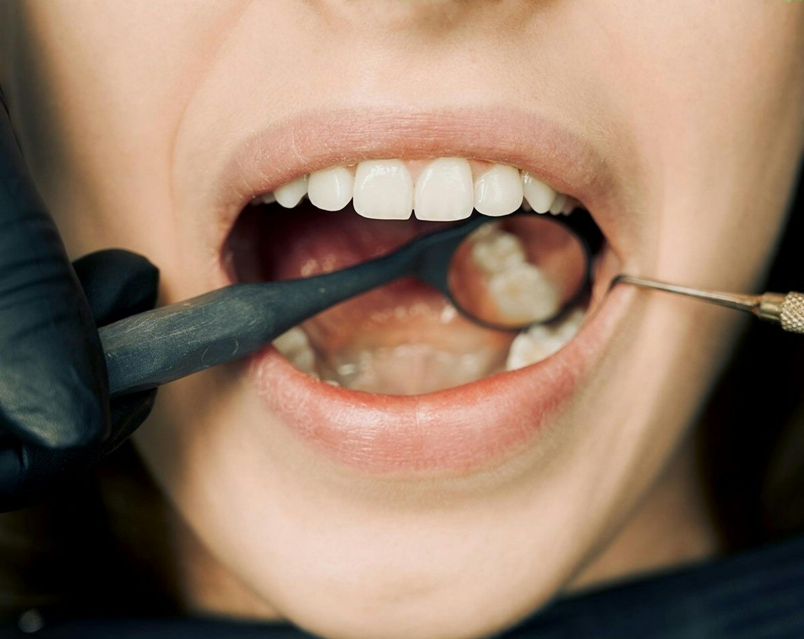 Close-up of a dental exam with a mirror and probe inside a patient's mouth.