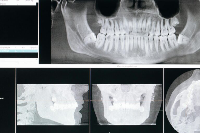 Panoramic dental X-ray on a screen showing teeth and jaw structure.