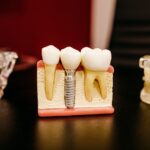Dental teaching model showing a crown attached to an implant post in the jaw beside natural teeth